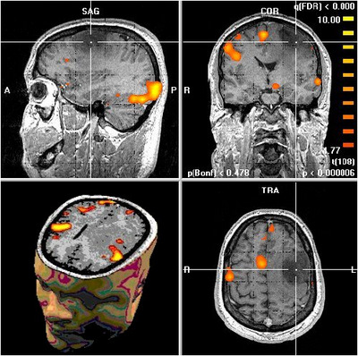 Onderzoekers: hersens te grillig om depressie, schizofrenie of ADHD vast te stellen met fMRI-scan