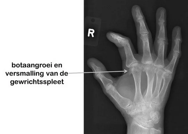 Patiënten met ijzerstapelingsziekte kunnen voortaan kiezen voor aderlating aan huis