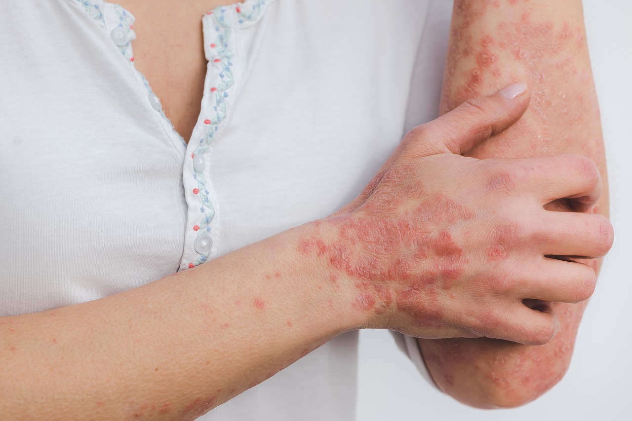 Ruimte voor verbetering bij behandeling psoriasis of eczeem door huisarts