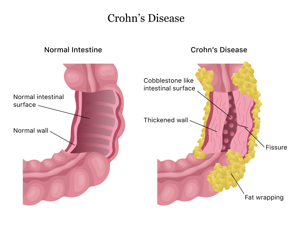 Patiënten met de ziekte van Crohn kunnen vaak toe met minder medicatie